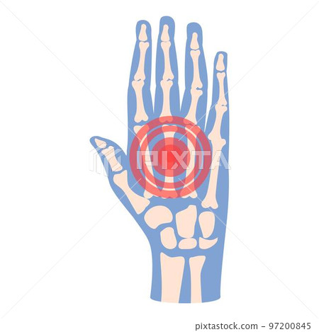 Hand pain icon cartoon vector. Arthritis joint. Medical patient 97200845