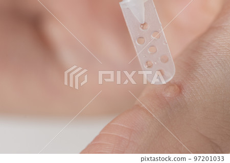 Wart treatment process. The doctor applies the medicine with a special spatula to the wart. Getting rid of a benign formation on human skin by using a medicine. Wart treatment process. The doctor applies the medicine with a special spatula to the wart. Getting rid of a benign formation on human skin by using a medicine. 97201033