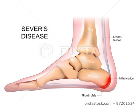 Severs disease. calcaneus apophysitis. inflammation at the back of the heel growth plate. 97201534