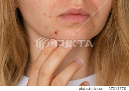 Unrecognizable woman showing her acne on face. Close-up acne on woman's face with rash skin ,scar and spot that allergic to cosmetics. Problem skincare and health concept. Wrinkles, melasma, dark Unrecognizable woman showing her acne on face. Close-up acne on woman's face with rash skin ,scar and spot that allergic to cosmetics. Problem skincare and health concept. Wrinkles, melasma, dark 97215778