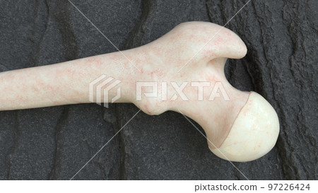 osteoporosis thigh bones from the outside - 3d rendering osteoporosis thigh bones from the outside - 3d rendering 97226424
