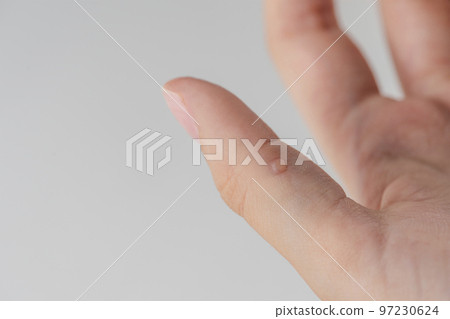 Wart on hand. The concept of treating warts and other skin defects. Close-up of a wart on a finger, a benign growth on human skin. 97230624
