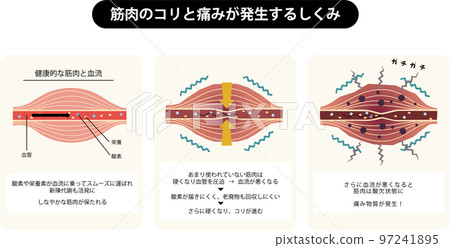 Illustration of the mechanism that blood flow and stiffness in healthy muscles cause pain due to poor blood flow 97241895