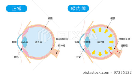 正常眼和青光眼眼的橫截面 97255122