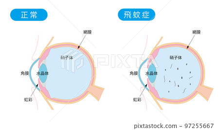 正常眼睛和有飛蚊症的眼睛的橫截面 97255667