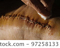 Surgical suture on the knee. Surgical wound sutured with special metal suture for healing. Total knee joint replacement. Close-up. 97258133