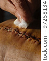 Surgical suture on the knee. Surgical wound sutured with special metal suture for healing. Total knee joint replacement. Close-up. 97258134