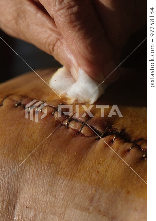 Surgical suture on the knee. Surgical wound sutured with special metal suture for healing. Total knee joint replacement. Close-up. Surgical suture on the knee. Surgical wound sutured with special metal suture for healing. Total knee joint replacement. Close-up. 97258134