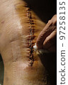 Surgical suture on the knee. Surgical wound sutured with special metal suture for healing. Total knee joint replacement. Close-up. 97258135