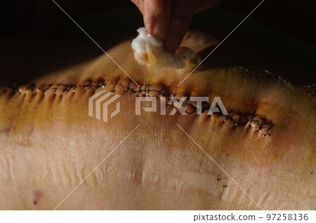 Surgical suture on the knee. Surgical wound sutured with special metal suture for healing. Total knee joint replacement. Close-up. 97258136