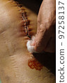 Surgical suture on the knee. Surgical wound sutured with special metal suture for healing. Total knee joint replacement. Close-up. 97258137