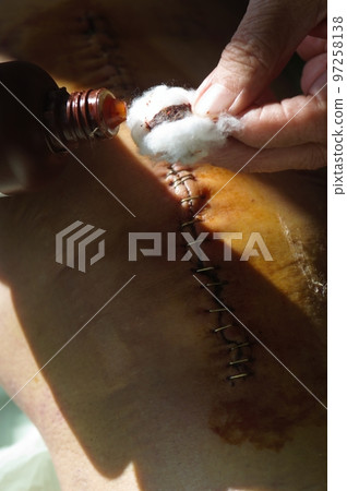 Surgical suture on the knee. Surgical wound sutured with special metal suture for healing. Total knee joint replacement. Close-up. Surgical suture on the knee. Surgical wound sutured with special metal suture for healing. Total knee joint replacement. Close-up. 97258138