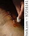 Surgical suture on the knee. Surgical wound sutured with special metal suture for healing. Total knee joint replacement. Close-up. 97258141