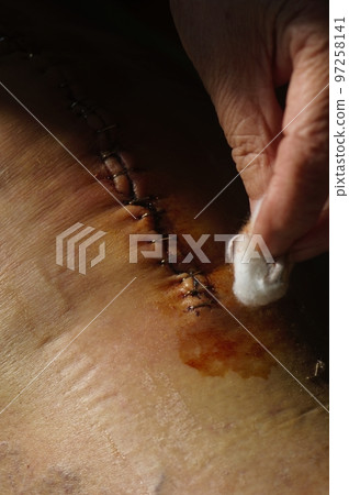 Surgical suture on the knee. Surgical wound sutured with special metal suture for healing. Total knee joint replacement. Close-up. 97258141