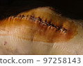 Surgical suture on the knee. Surgical wound sutured with special metal suture for healing. Total knee joint replacement. Close-up. 97258143