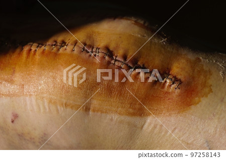 Surgical suture on the knee. Surgical wound sutured with special metal suture for healing. Total knee joint replacement. Close-up. 97258143