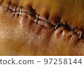 Surgical suture on the knee. Surgical wound sutured with special metal suture for healing. Total knee joint replacement. Close-up. 97258144
