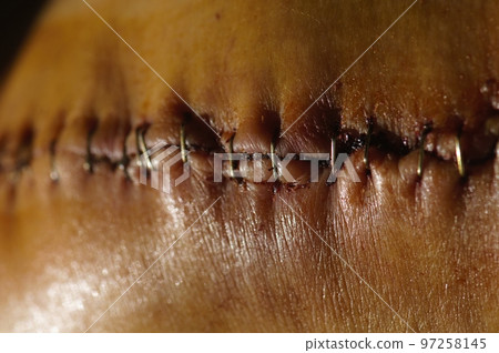 Surgical suture on the knee. Surgical wound sutured with special metal suture for healing. Total knee joint replacement. Close-up. Surgical suture on the knee. Surgical wound sutured with special metal suture for healing. Total knee joint replacement. Close-up. 97258145