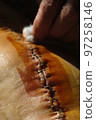 Surgical suture on the knee. Surgical wound sutured with special metal suture for healing. Total knee joint replacement. Close-up. 97258146