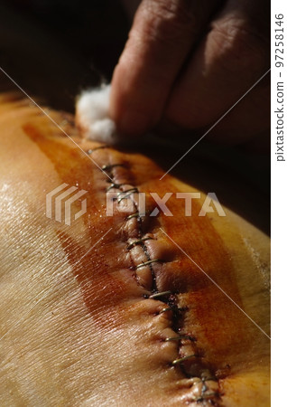 Surgical suture on the knee. Surgical wound sutured with special metal suture for healing. Total knee joint replacement. Close-up. Surgical suture on the knee. Surgical wound sutured with special metal suture for healing. Total knee joint replacement. Close-up. 97258146
