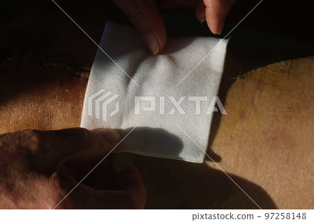 Surgical suture on the knee. Surgical wound sutured with special metal suture for healing. Total knee joint replacement. Close-up. Surgical suture on the knee. Surgical wound sutured with special metal suture for healing. Total knee joint replacement. Close-up. 97258148