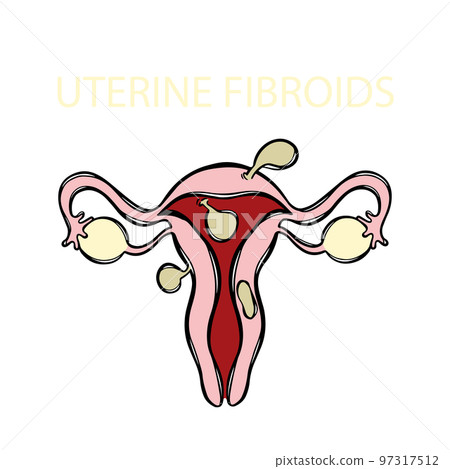 UTERINE FIBROIDS Leiomyoma Benign Tumor Of The Smooth Muscles Of The Uterus Painful Or Severe Menstruation Medical Education Banner Vector Illustration Scheme 97317512