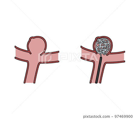 Cerebral artery coil embolization Cerebral artery coil embolization 97469900
