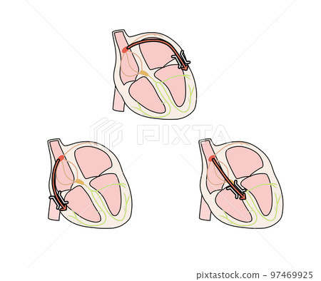 WPW Syndrome (A/B/C) 97469925