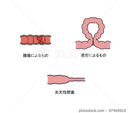 單純性腸梗阻 97469928