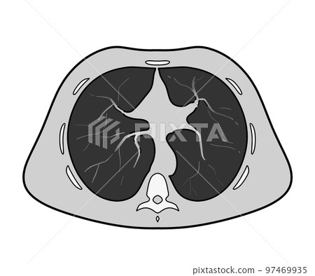 Multi-slice CT (chest) 97469935