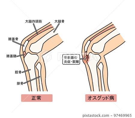 奧斯古德病 97469965
