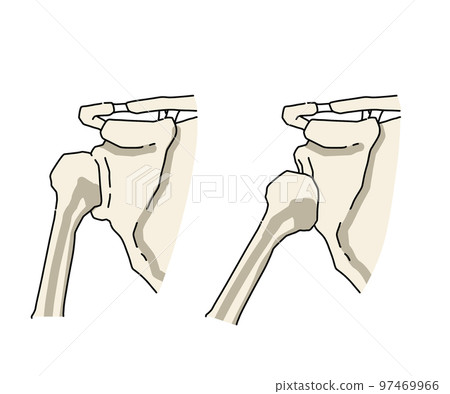 Shoulder joint dislocation 97469966