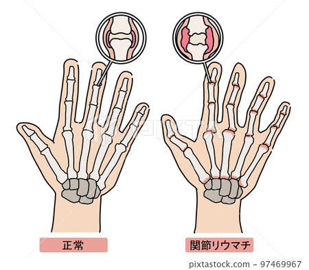 rheumatoid arthritis 97469967