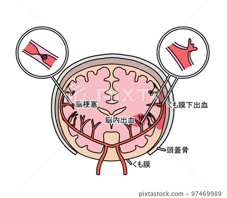 腦血管疾病 97469989
