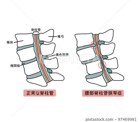 Lumbar spinal stenosis 97469991