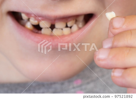 The child holds a milk tooth incisor in his hand. Extraction of milk teeth in children. Children's dentistry. Close-up 97521892