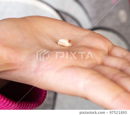 The child holds a milk tooth incisor in his hand. Extraction of milk teeth in children. Children's dentistry. Close-up The child holds a milk tooth incisor in his hand. Extraction of milk teeth in children. Children's dentistry. Close-up 97521893