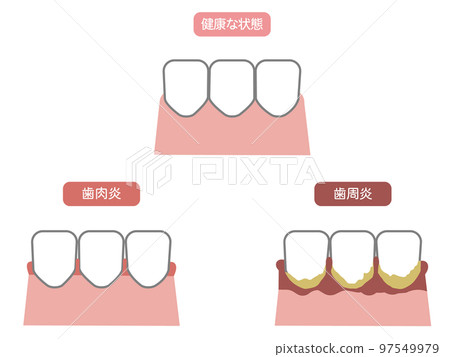 健康牙齒、牙周病和牙齦炎的例證 2 97549979