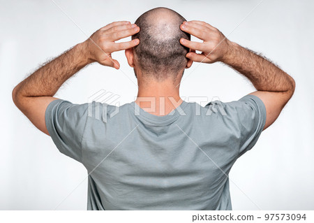 A man holds his hands over his bald head, demonstrating focal alopecia. Rear view. The concept of baldness and male alopecia A man holds his hands over his bald head, demonstrating focal alopecia. Rear view. The concept of baldness and male alopecia 97573094