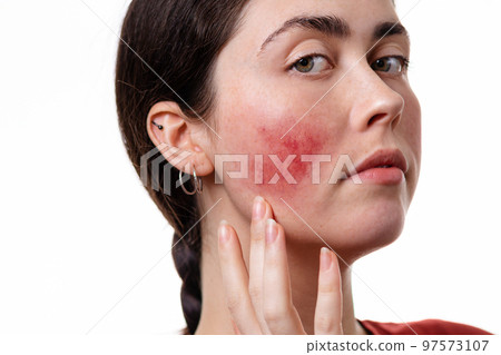 Close up portrait of a young Caucasian woman in close-up showing rosacea on her cheeks with her hand. White background. Rosacea and inflammation on the face 97573107