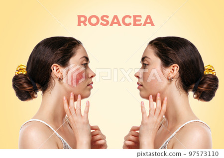 Before and after. Portrait of a young woman with rosacea on her cheek, side view. Beige background. Side view. Concept of rosacea and treatment Before and after. Portrait of a young woman with rosacea on her cheek, side view. Beige background. Side view. Concept of rosacea and treatment 97573110