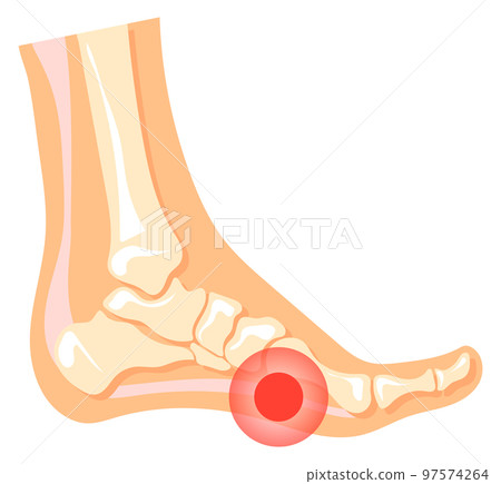 Leg pain. Red spot in human foot. Medical illustration Leg pain. Red spot in human foot. Medical illustration 97574264