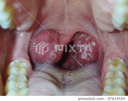 Tonsils. Angina. Tonsillitis. Bacterial disease produced in the tonsils that causes swelling and plaque. Bad mouth. Pus on the tonsils. Photography. 97624504