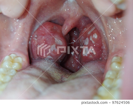 Tonsils. Angina. Tonsillitis. Bacterial disease produced in the tonsils that causes swelling and plaque. Bad mouth. Pus on the tonsils. Photography. Tonsils. Angina. Tonsillitis. Bacterial disease produced in the tonsils that causes swelling and plaque. Bad mouth. Pus on the tonsils. Photography. 97624506