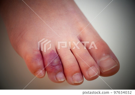 凍傷孩子的腳 凍傷孩子的腳 97634032