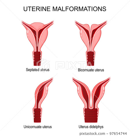 uterine malformations 97654744