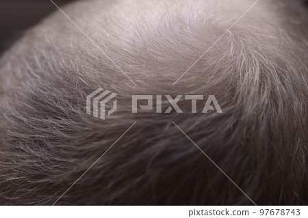Men hair loss problem alopecia Men hair loss problem alopecia 97678743