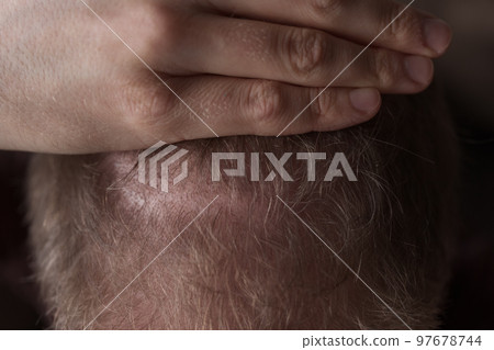 Men hair loss problem alopecia Men hair loss problem alopecia 97678744
