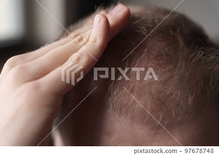 Men hair loss problem alopecia Men hair loss problem alopecia 97678748