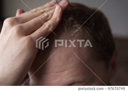 Men hair loss problem alopecia - Stock Photo [97678749] - PIXTA